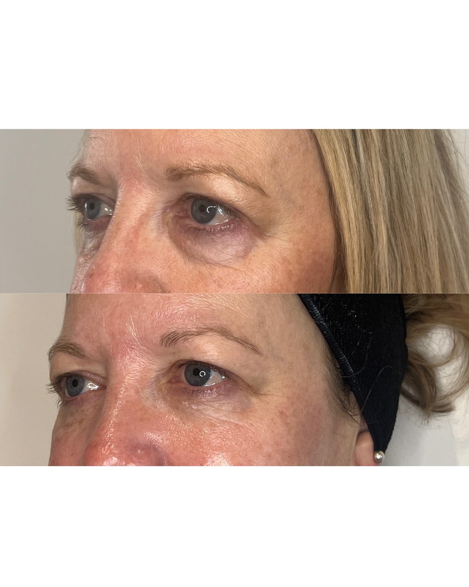 Under eye before treatment