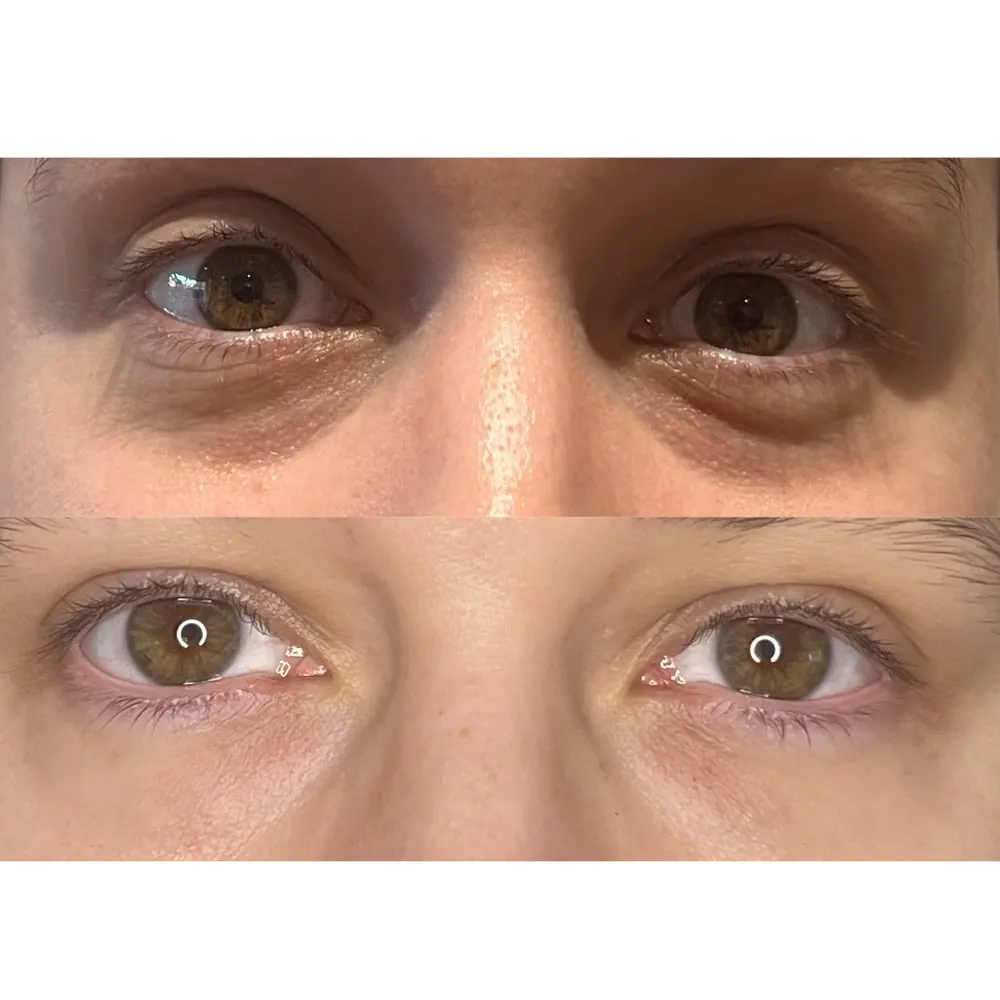 Before and after under eye result
